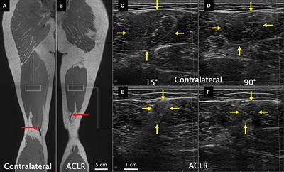 Semitendinosus muscle morphology in relation to surface electrode placement in anterior cruciate ligament reconstructed and contralateral legs